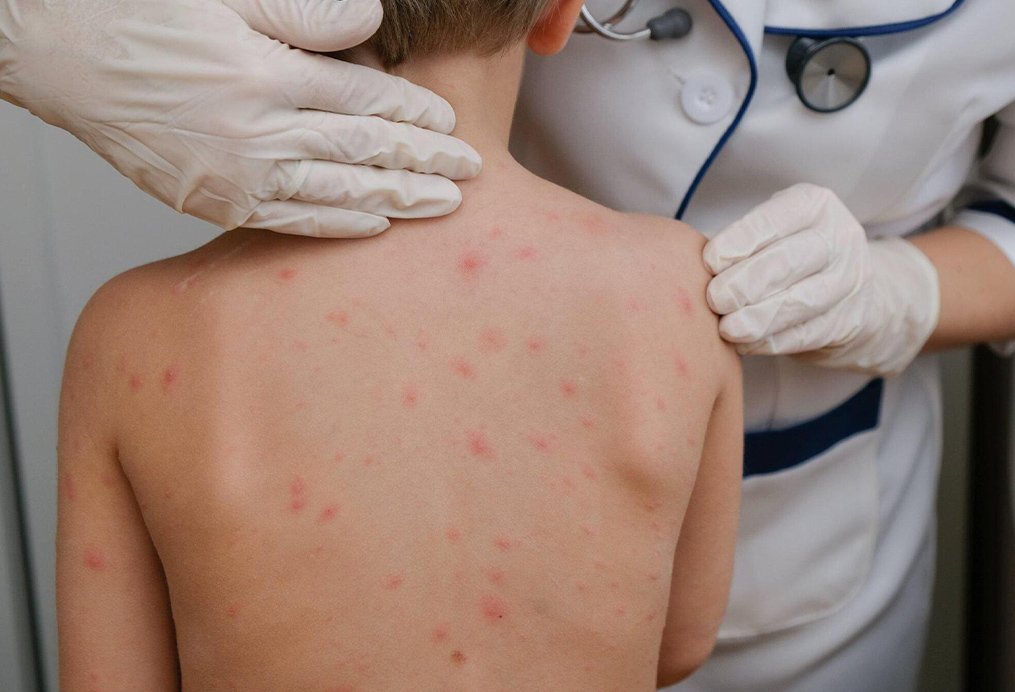 Varicella Chickenpox Vaccine